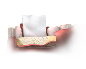 Injerto de hueso y membrana reabsorbible en implantes dentales